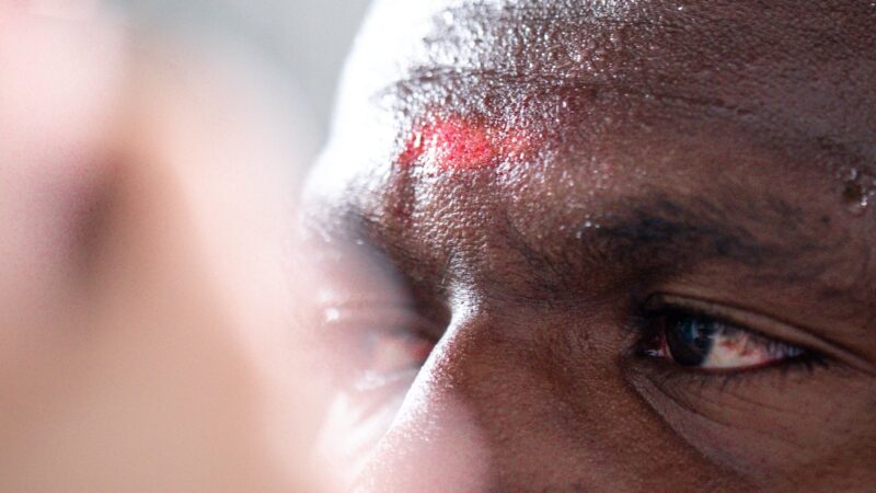 Coritiba posta foto de Jacy com rosto ferido e reclama de pênalti não marcado; veja