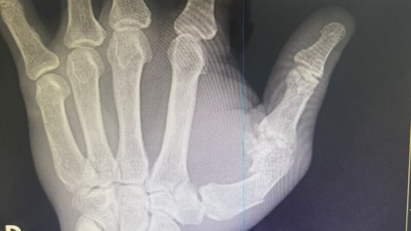 Popó passa por cirurgia na mão em Salvador após briga generalizada