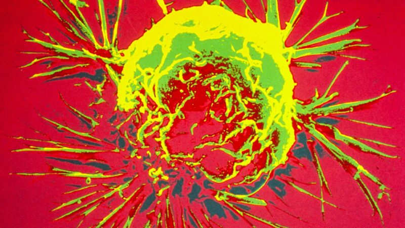 Mutação ligada a câncer grave é transmitida por doador de sêmen a pelo menos 197 crianças na Europa