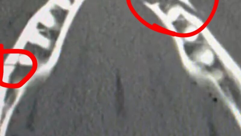 Jake Paul fratura a mandíbula em luta com Anthony Joshua; veja imagem