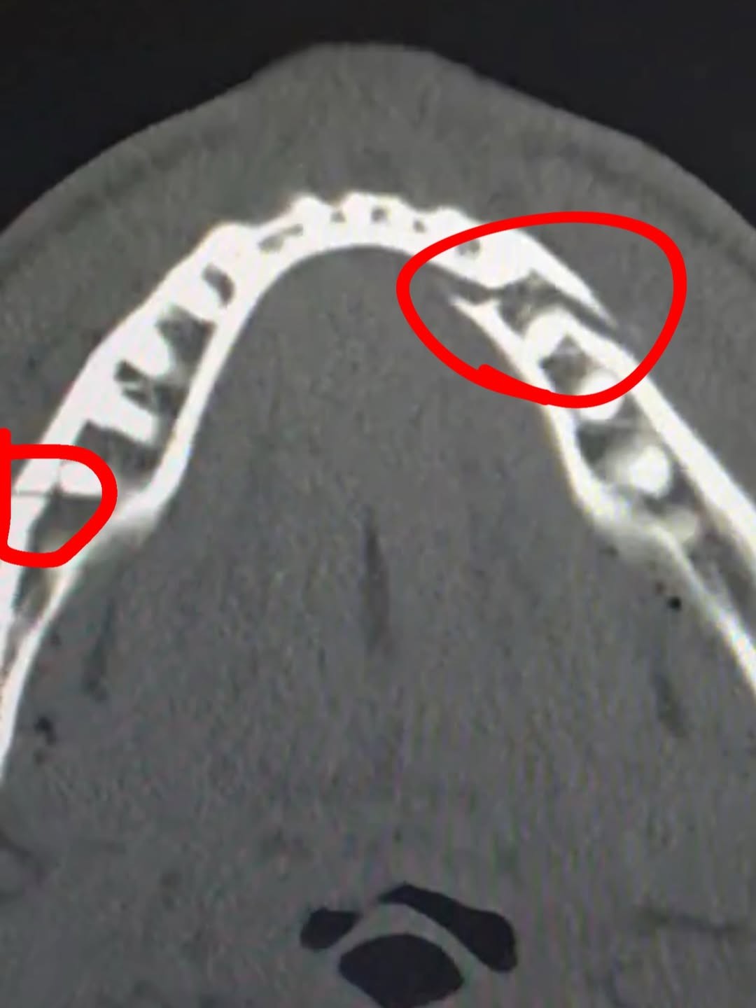 Jake Paul fratura a mandíbula em luta com Anthony Joshua; veja imagem