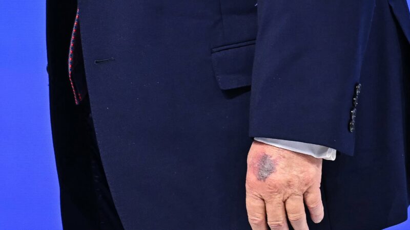 Hematoma na mão de Trump volta a chamar atenção em Davos
