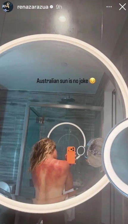 Tenista mexicana expõe queimaduras solares e alerta para risco do calor na Austrália; veja foto