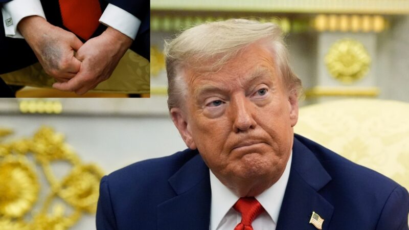 Trump culpa aspirina por hematomas nas mãos e nega cochilar em público