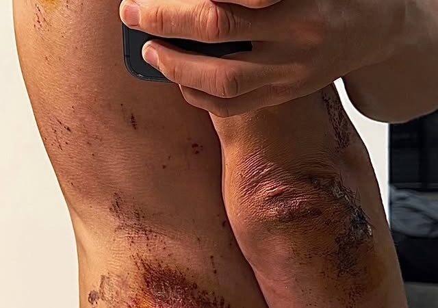 Kwiatkowski exibe escoriações após queda violenta: “Machucado, mas sem ossos quebrados”