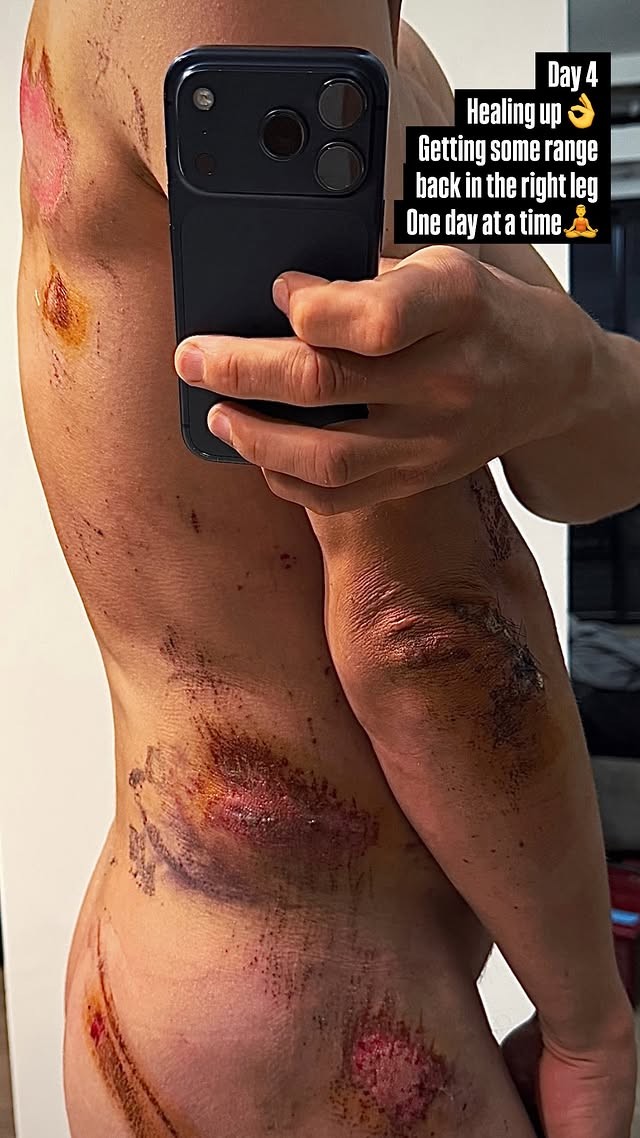 Kwiatkowski exibe escoriações após queda violenta: “Machucado, mas sem ossos quebrados”