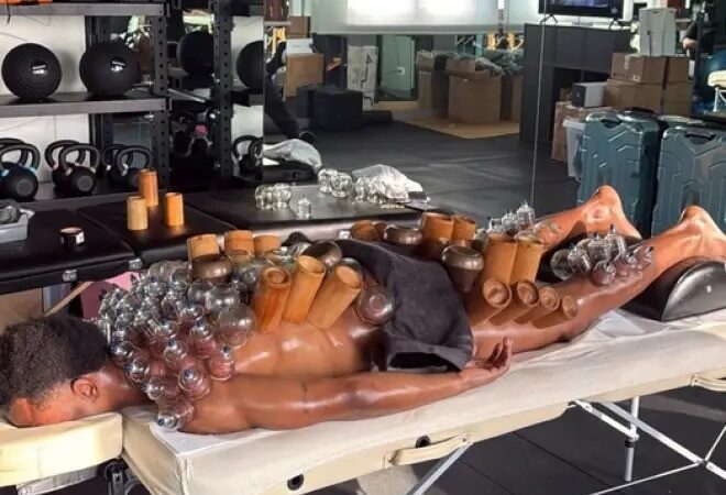 Imagem de jogador da Juventus com ventosas viraliza; entenda o tratamento