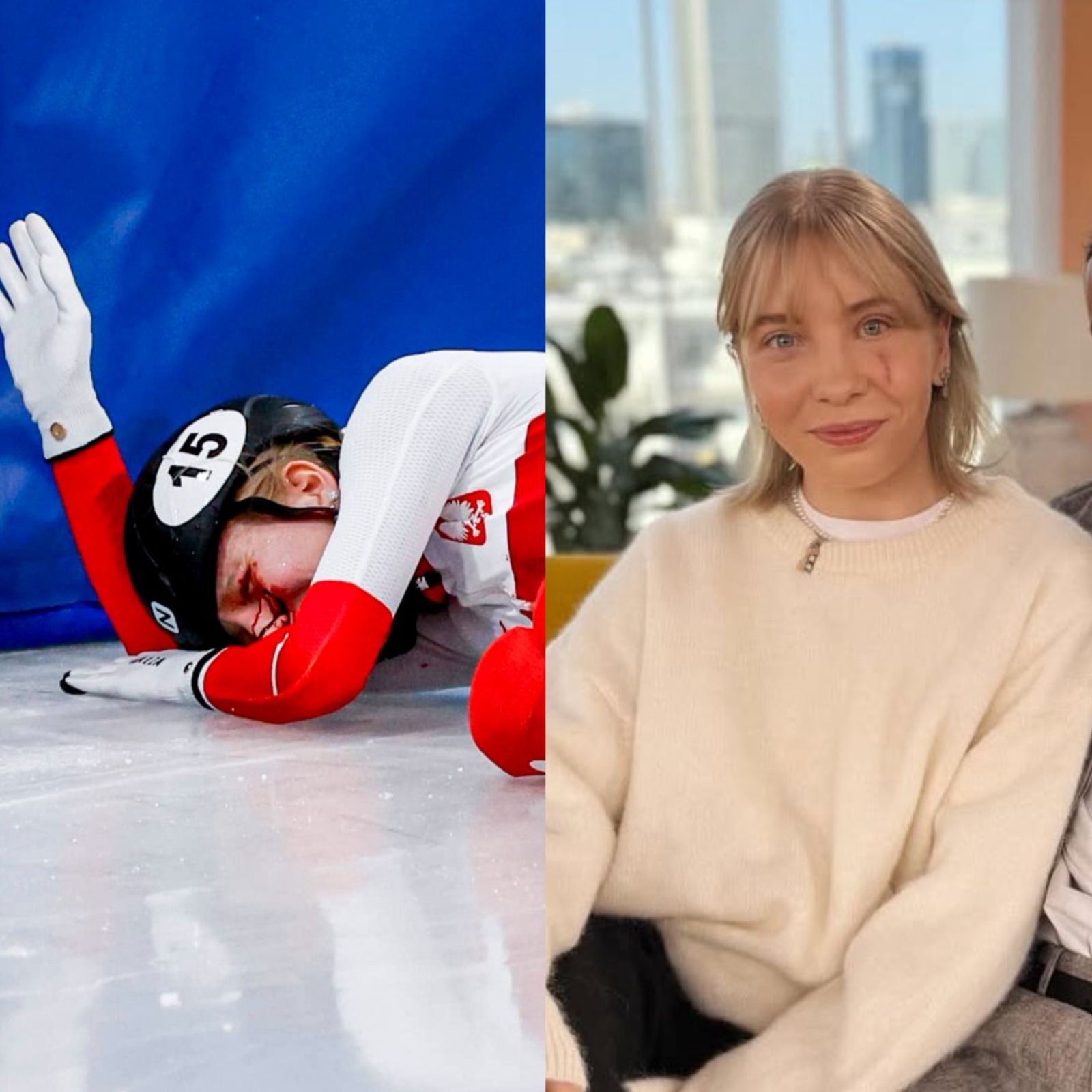 Polonesa atingida por lâmina nos Jogos de Inverno mostra cicatriz no rosto: “Enxergo duplicado”