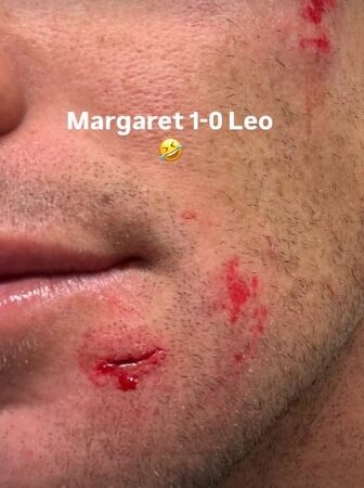 Imagens fortes: Leo Fioravanti sofre cortes no rosto em Margaret River