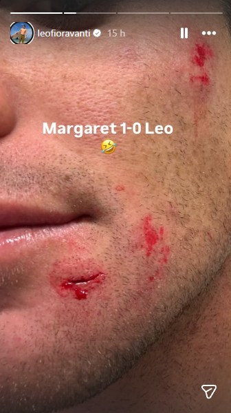 Imagens fortes: Leo Fioravanti sofre cortes no rosto em Margaret River