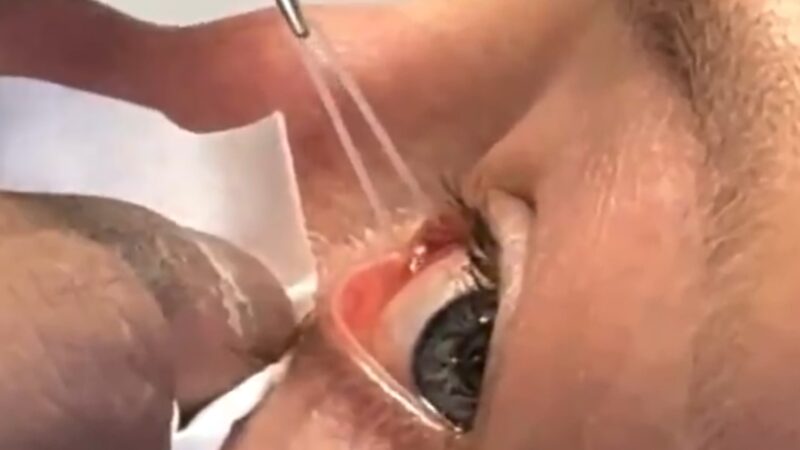 Rose Namajunas retira tubo do olho após cirurgia; veja o vídeo