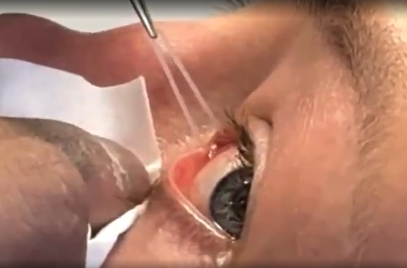 Rose Namajunas retira tubo do olho após cirurgia; veja o vídeo