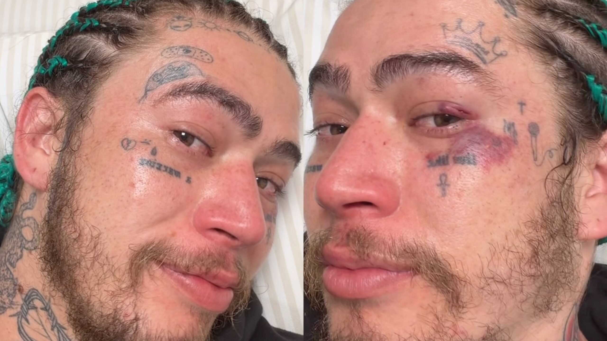 Whindersson “se esconde” de Popó no ringue e mostra saldo final de como ficou seu rosto após a luta
