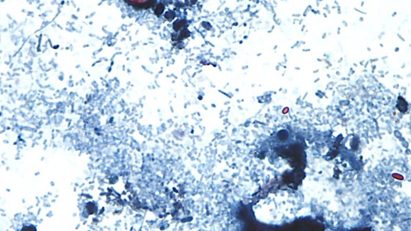 Parasita que provoca ‘diarreia explosiva’ infecta mais de 2,8 mil pessoas nos EUA; investigação aponta alface como suspeita