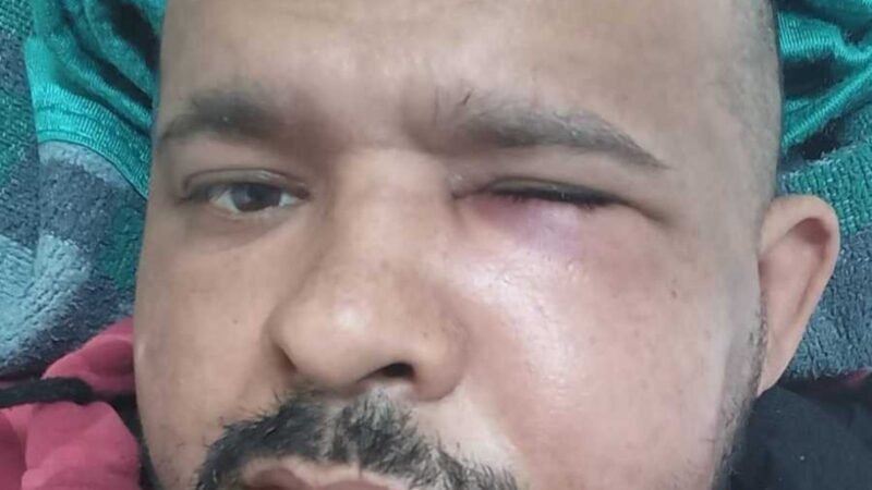 Árbitro agredido em jogo da várzea terá que passar por nova cirurgia: “Não consigo mastigar”