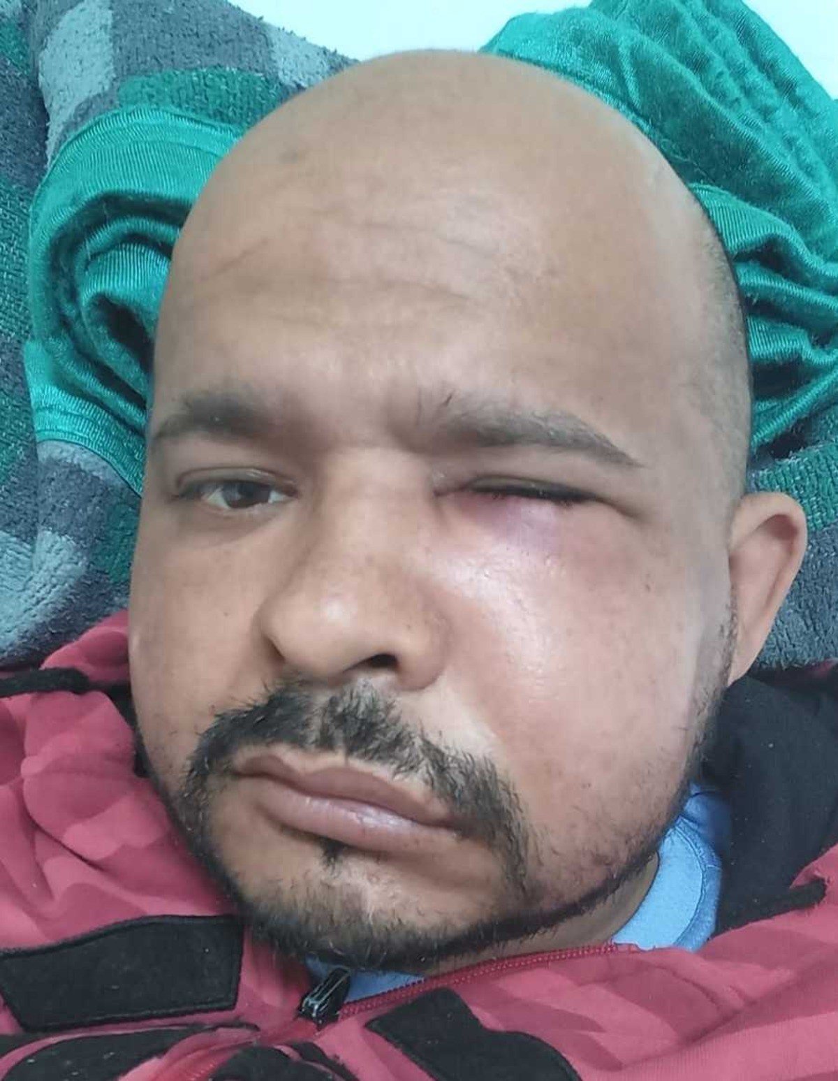 Árbitro agredido em jogo da várzea terá que passar por nova cirurgia: “Não consigo mastigar”