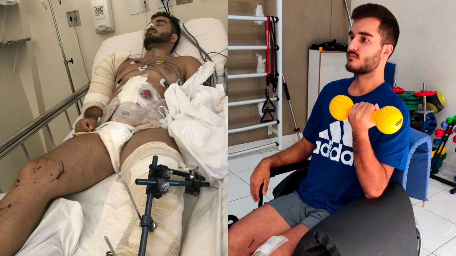 Bauruense que quase perdeu a perna supera acidente e se prepara para maratona de Buenos Aires